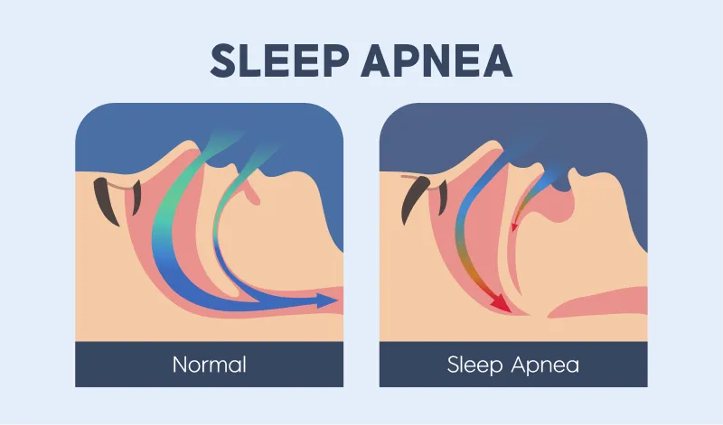 Side section illustrations that shows the airway of a normal person and a person with sleep apnea while asleep